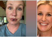 Jenny Marrs Lips surgery