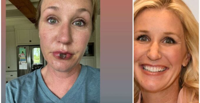 Jenny Marrs Lips surgery